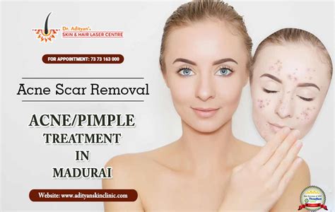 Acne/Pimple Scar Treatment — How to Cure Pimples in an Effective Way? | by demardstarine | Medium