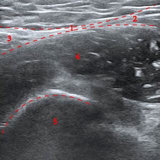 Fascia iliaca compartment block: bow-tie in the iliac fascia region on ...