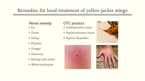 Treatment For Yellow Jacket Sting | Parents Republic