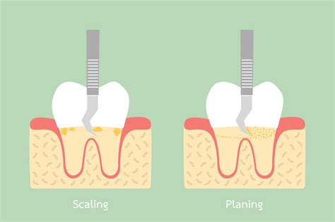 Dental Scaling | Procedure, Hygiene Benefits, Types of Deep Scaling & Costs