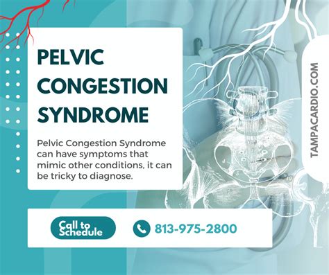 Pelvic Congestion Syndrome: Causes, Symptoms, and Treatment, pelvic ...