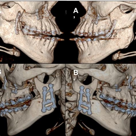 Three-dimensional presentation of a bilateral sagittal split osteotomy... | Download Scientific ...