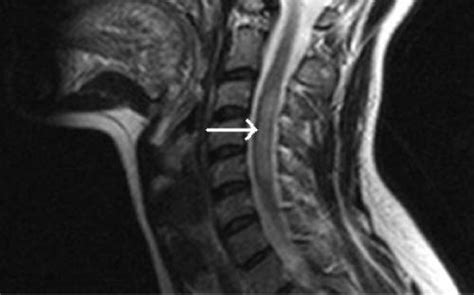 Transverse Myelitis - Neurology - Medbullets Step 2/3