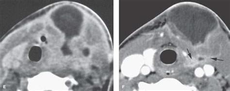 Hypopharynx: Developmental Abnormalities | Radiology Key