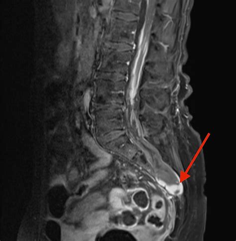 Tarlov Cyst Rupture and Intradural Hemorrhage Mimicking Intraspinal ...