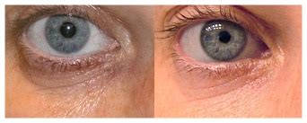 Dark Circles Surgery What Are The Options? | Under Eye Circles Treatments