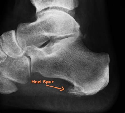 Heel Spur X Ray