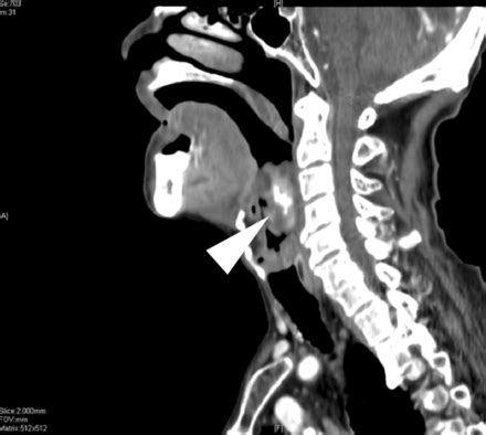 Airway obstruction caused by retro-laryngeal carcinosarcoma | BMJ Case Reports