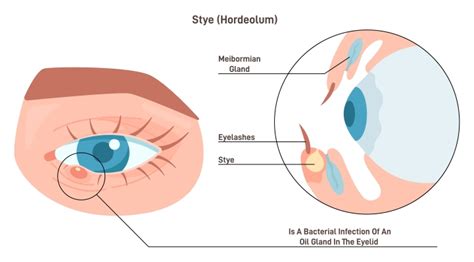 Hordeolum Vs Chalazion