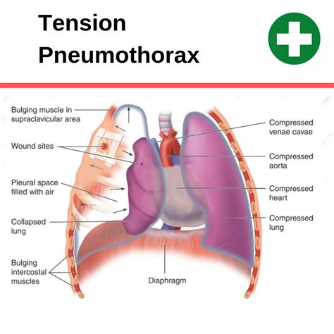 Tension Pneumothorax: What Is It, Causes, Signs, Symptoms,, 52% OFF