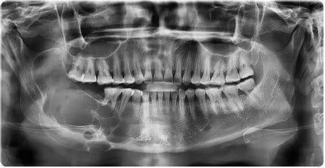 Recent advances in Treatment of Ameloblastoma