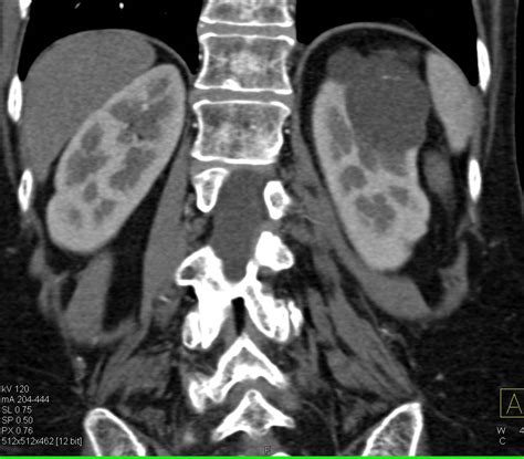 Bosniak Type II Cyst Left Kidney - Kidney Case Studies - CTisus CT Scanning