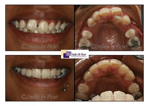 Six Month Braces | Charlotte, Matthews, Lake Norman Dentist