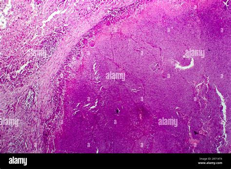 Caseation of human tuberculosis granuloma, light micrograph, photo ...