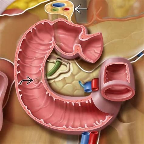 Imaging Approach to the Duodenum | Radiology Key