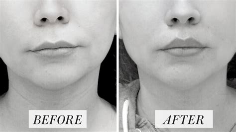 What Is a Lip Lift? Doctors Explain the Plastic Surgery Procedure That Could Replace Lip Filler ...