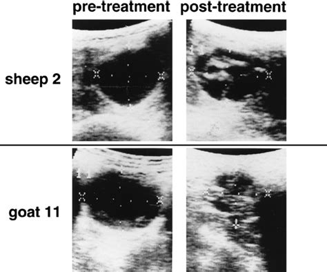 Ultrasound changes in hydatid cysts in liver tissue before and after 4 ...