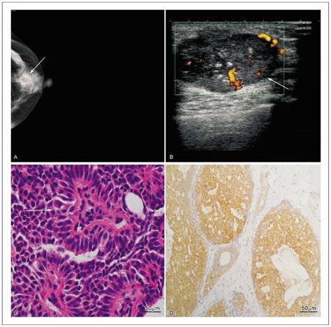 A, a craniocaudal mammogram of the right breast shows an abnormal ...