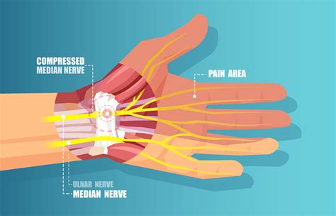 What is Carpal Tunnel Syndrome? — Orthopedics Hawaii