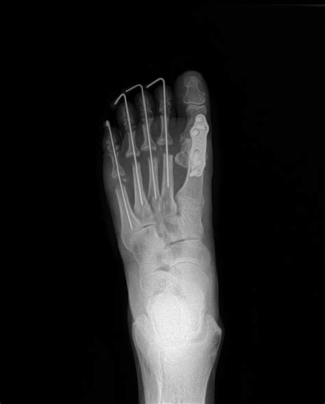 Rheumatoid Arthritis And Foot Pain: Foot and Ankle Institute of Colorado: Podiatrists