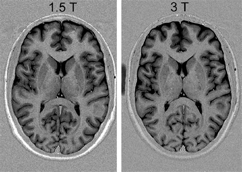 3 Tesla Mri Disadvantages