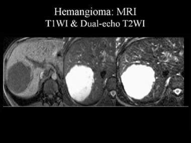 Cavernous Liver Hemangioma Imaging: Practice Essentials, Computed ...