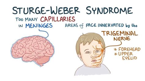 Osler Weber Rendu Syndrome