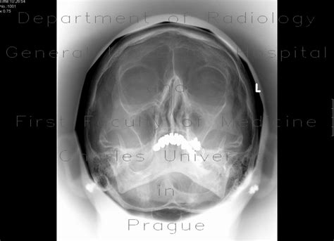 Radiology case: Chronic sinusitis of the left maxillary sinus