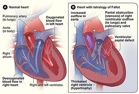 What is Congenital Heart Disease - Types, Causes, and Symptoms
