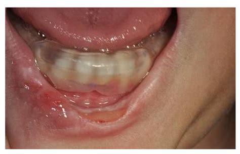 Reports | Free Full-Text | Management and Prevention of Oral Self ...