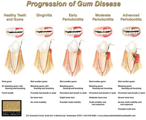 Gum Disease | ThirtyTwo Dental