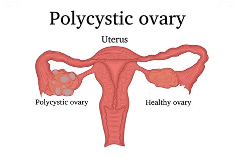 7 signs you might have polycystic ovarian syndrome | Queensland Health