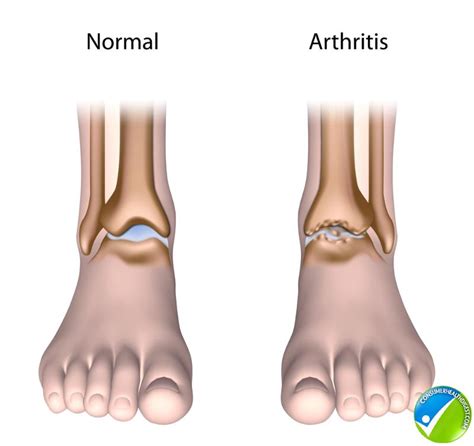 Foot And Ankle Arthritis: Causes, Symptoms And Treatment