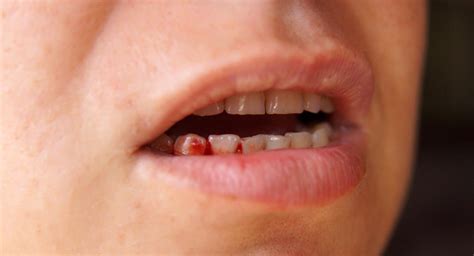 Bleeding gums in pregnancy | BabyCentre