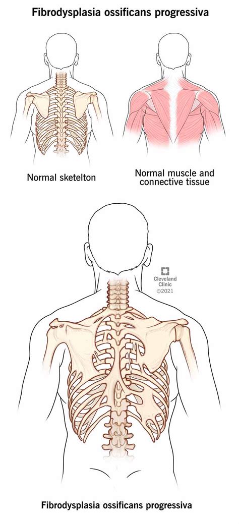 Fibrodysplasia Ossificans Progressiva: Põhjused, Sümptomid, Ravi, Väljavaade - SFOMC