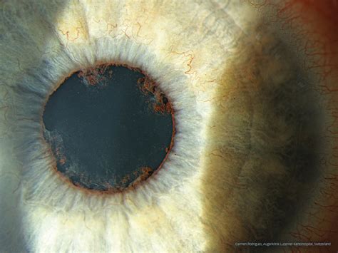 Posterior Synechiae