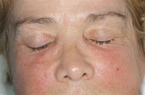 Adult-onset Still's disease revealed by facial edema - Journal of the American Academy of ...