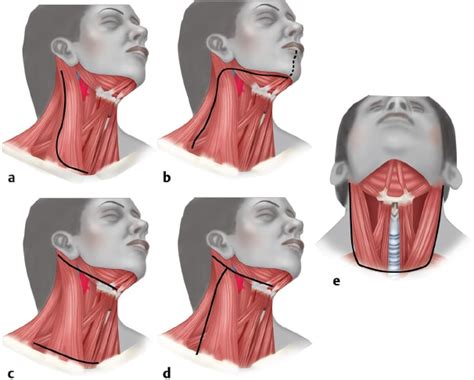 Modified Neck Dissection surgery cost in Bangalore - Find the Best ...