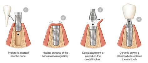 Dental Implants can restore Missing or Damaged Teeth