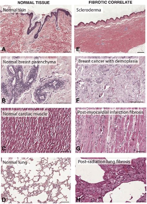 Lung Fibrosis Histology