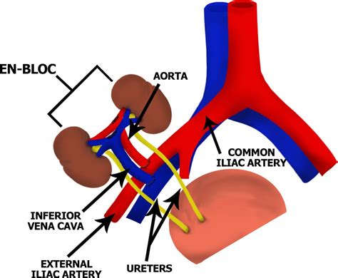 Expanding Opportunities for Kidney Transplantation | IntechOpen