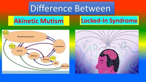 Akinetic Mutism Vs. Locked-In Syndrome - YouTube