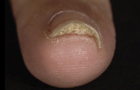 Dried Skin Around Fingernails - Nail Ftempo