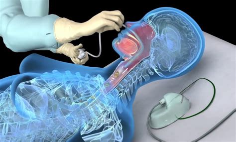 Uses of Suction Tubes in Surgeries & Its type - Post Pear - Guest ...