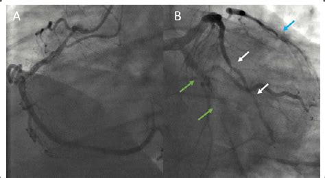 Preoperative coronary angiography of case 1, revealing triple vessel... | Download Scientific ...