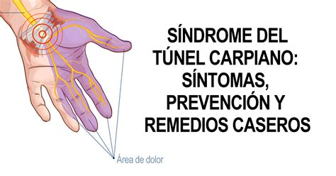 Sindrome Del Tunel Carpiano