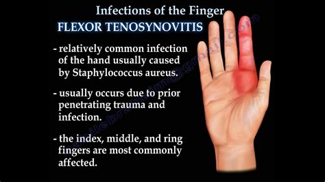 Infections Of The Finger - Everything You Need To Know - Dr. Nabil ...