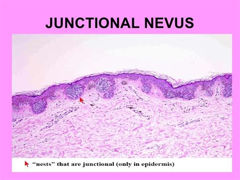 General pathology lecture 7 neoplasms