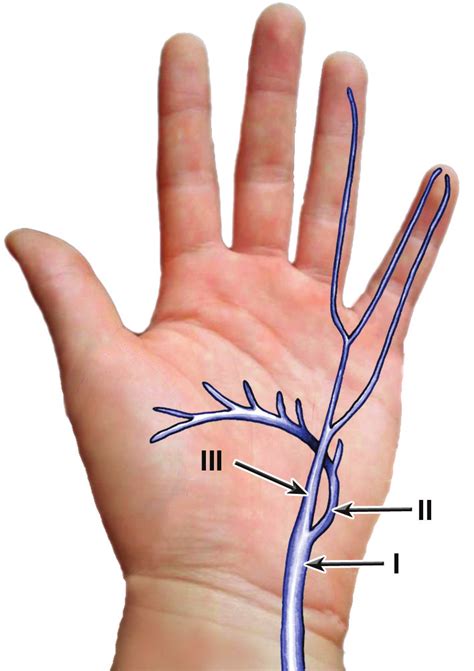 Shea and McClain's subdivision of the lesions of ulnar nerve in the... | Download Scientific Diagram