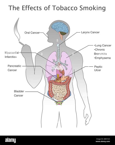 Side effects of smoking hi-res stock photography and images - Alamy